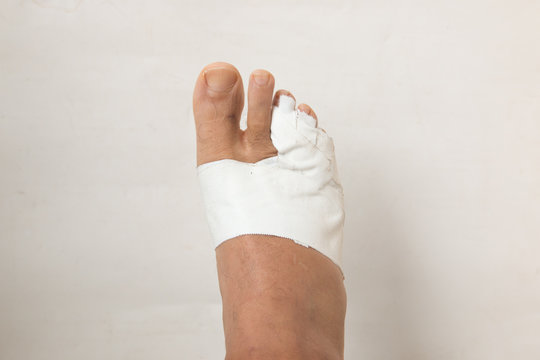 Close up of a Man&rsquo;s bandaged up broken toe 