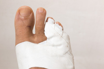 Close up of a Man’s bandaged up broken toe 