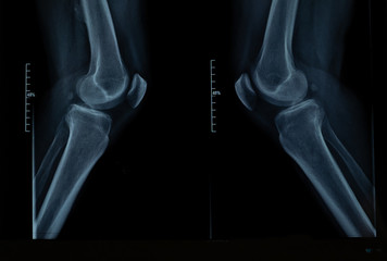 X-ray of knee joints