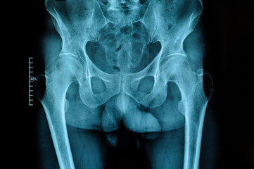 X-ray of the hip joints of an adult male with osteoarthritis. Selective focus. Blur. Noise,...