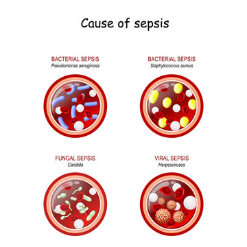 Cause Of Sepsis. Close-up Of Cross Section Of Blood Vessel With Red Blood Cells, Leukocytes, And  Infection.