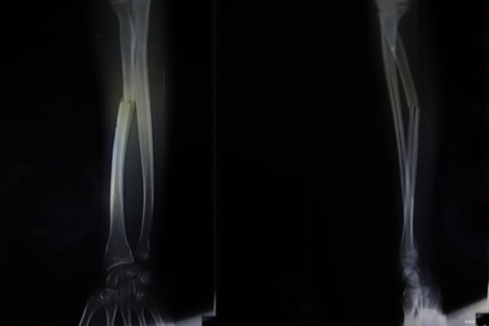 Broken hand bone x ray film