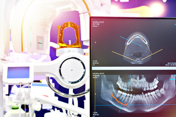 Dental digital tomograph
