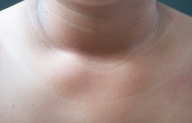 Skin on the neck that is blackened due to abnormalities of the body