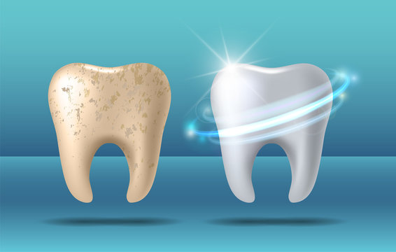 Clean And Dirty Tooth Before And After Whitening