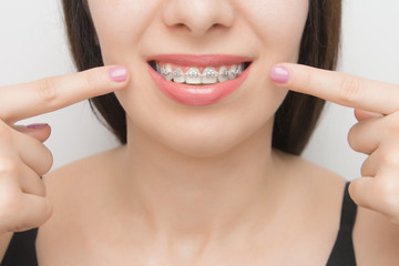 Dental braces in happy womans mouths who shows by two fingers on brackets on the teeth after whitening. Self-ligating brackets with metal ties and gray elastics or rubber bands for perfect smile.