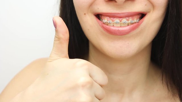 Dental braces in happy womans mouths who shows like. Brackets on the teeth after whitening. Self-ligating brackets with metal ties and gray elastics or rubber bands for perfect smile. Orthodontic teet