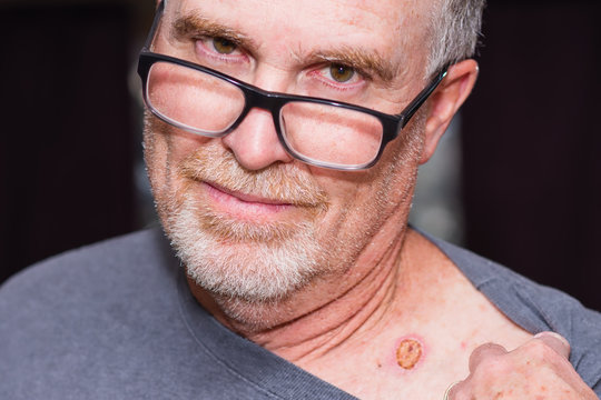 Portrait Of A Senior Man Showing His Scar From Skin Cancer