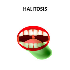 bad breath. Halitosis. The structure of the teeth and oral cavity. Diseases of the teeth. Infographics. Vector illustration on isolated background.