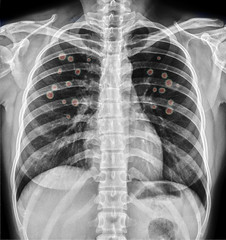 Novel Covid-19, Wuhan virus concept , Chest x-ray Coronavirus of lungs radiology