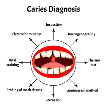 Diagnosis of caries. Bad breath. Halitosis. The structure of the teeth and oral cavity with caries. Diseases of the teeth. Infographics. Vector illustration on isolated background.