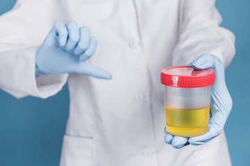 Doctor in white uniform and blue medical gloves hold a container for urine analysis and shows a sign bad with his hand