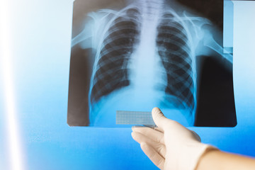 Doctor examines an x-ray photograph in a hospital