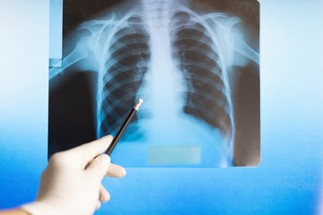 Doctor examines an x-ray photograph in a hospital