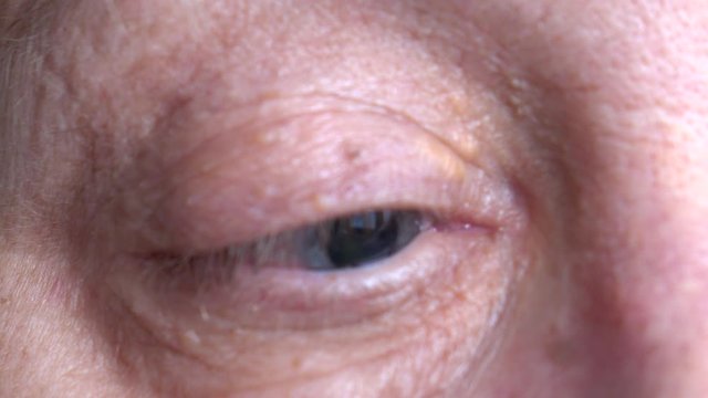 Eye of an elderly woman after using medical atropine before eye examinations