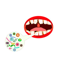 caries. Smell from the mouth. Halitosis. The structure of the teeth and oral cavity. Diseases of the teeth caries. Infographics. Vector illustration on isolated background.