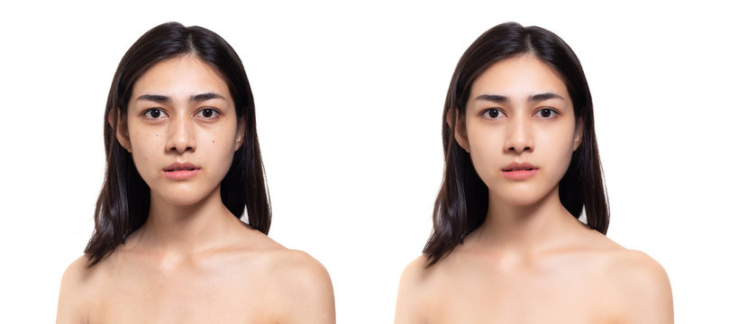 Cosmetology concept. Beauty young asian woman has freckles, blemish, acne, dull skin compare another side beautiful woman has clear and nice skin face, body after get treatment of cosmetology spa