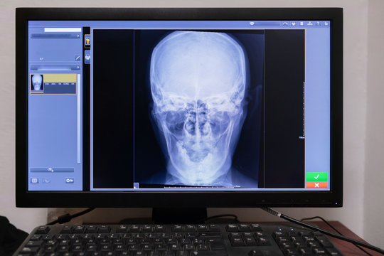 skull displayed on x-ray monitor