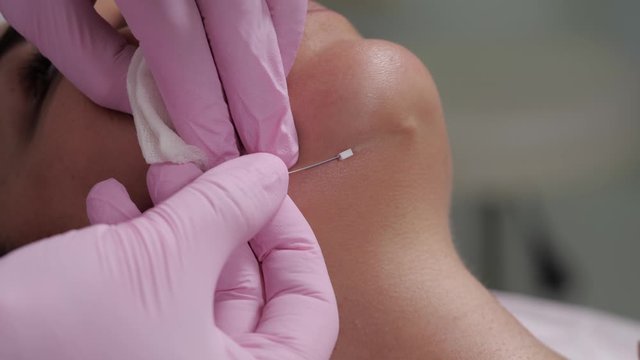 The procedure of lifting the face using special threads.