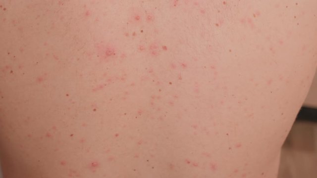 Close-up of chicken pox on the back of an adult male. Adult man who having varicella blister or chickenpox on a back, chicken pox disease.