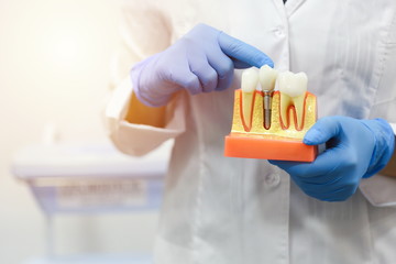 dental implant concept. the hands of a dentist doctor hold a model of teeth with an implant. 