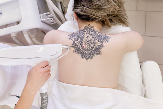 Top view hand of a beautician holds a laser device over a tattooed back of a girl to remove an unwanted tattoo. Concept of erasing tattoos as expensive procedure in beauty parlor modern vedical clinic