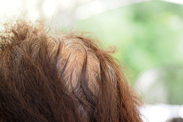 Closeup back side of an old woman with her hair loss at the top of the head due to getting old age and hair coloring. Grey hair also found when growing old. Medical and healthcare concept