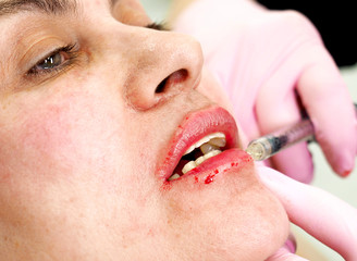 The process of lips enhancement. Doctor's hand injects botox into a woman's lips with a syringe....