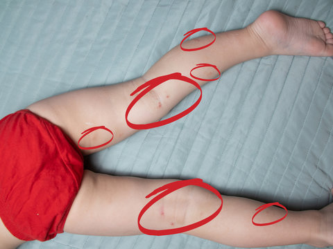 Allergic rash on the skin of the child's feet. Top view of the child's feet with traces on the skin from allergies. Children are allergic to sweets and flowers.