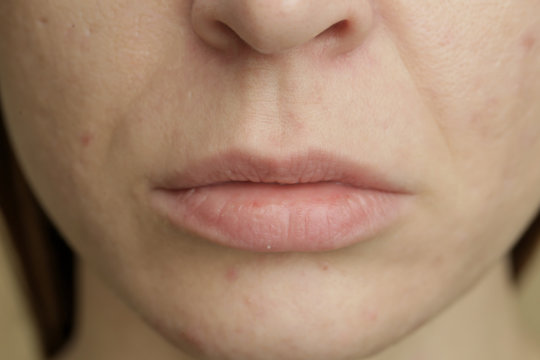 Close up of female face problematic sensitive skin with large pores, redness and acne 