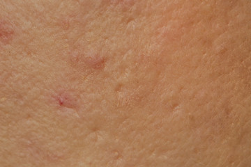 Close up of female face problematic sensitive skin with large pores, redness and acne 