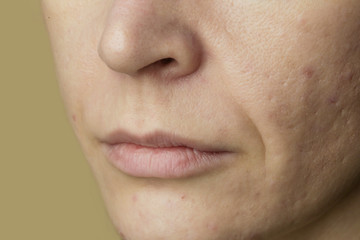 Fototapeta premium Close up of female face problematic sensitive skin with large pores, redness and acne 