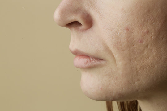 Close up of female face problematic sensitive skin with large pores, redness and acne 