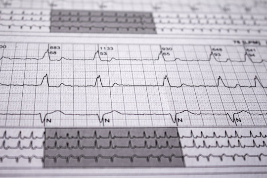 Heartbeat represented on paper. Cardiac arrhythmias. Selective focus on some beats. Atrial fibrillation Intraventricular conduction disorder Free space to write.