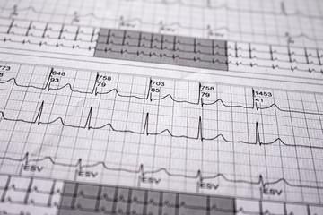 Heartbeat represented on paper. Cardiac arrhythmias. Selective focus on some beats. Free space to write.