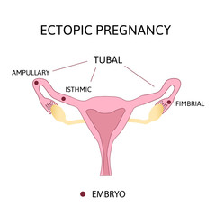 Ectopic Pregnancy. Types of Tubal pregnancy, ovarian, fimbrial.