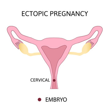 Ectopic Pregnancy. Types of Tubal pregnancy, ovarial, abdominal, cervical pregnancy. medical diagram with female repr