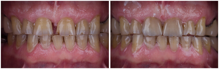 Obraz premium before and after picture of dental treatment by 2 unit press ceramic cowns