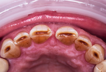 natural teeth before the dental treatment