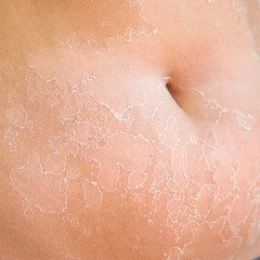 Fototapeta premium Sunburn on the female belly skin. Exfoliation, skin peels off.