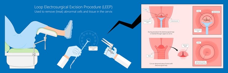 Cold knife cone biopsy Loop Electrosurgical Excision Procedure LEEP Large Loop Excision of the Transformation Zone LLETZ remove tissue from the cervix for precancerous cell laser diathermy per treat