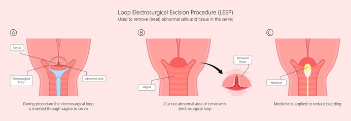 Cold knife cone biopsy Loop Electrosurgical Excision Procedure LEEP Large Loop Excision of the Transformation Zone LLETZ remove tissue from the cervix for precancerous cell laser diathermy per treat - obrazy, fototapety, plakaty