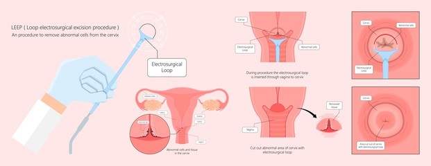 Cold knife cone biopsy Loop Electrosurgical Excision Procedure LEEP Large Loop Excision of the Transformation Zone LLETZ remove tissue from the cervix for precancerous cell laser diathermy per treat