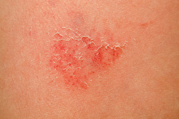 A large wound on the skin of a child close-up