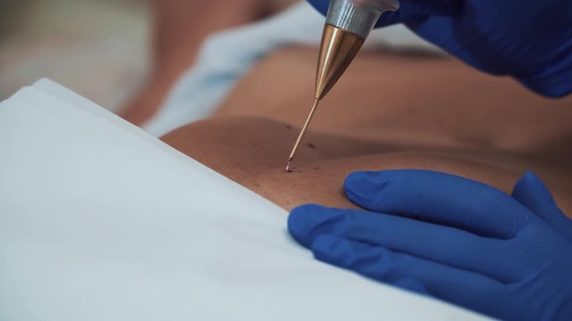 Doctor cosmetologist burns out mole with laser device in clinic of close up. Dermatologist removes birthmark and papilloma by vaporizing it with special beam of radiation in medical office