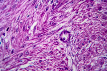 Uterine leiomyoma, also known as fibroids,a benign smooth muscle tumor of the uterus, light micrograph, photo under microscope