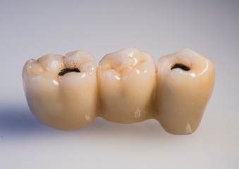 photo of macro dental implants