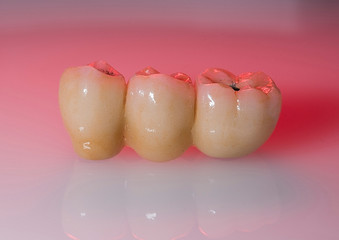 photo of macro dental implants