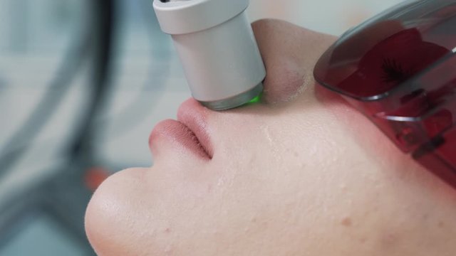 Close up of lips area on woman face during laser hair removal procedure