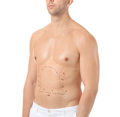 Fototapeta premium Young man with marks on his body against white background. Concept of plastic surgery